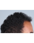 Before Hair Transplant&nbsp;Front